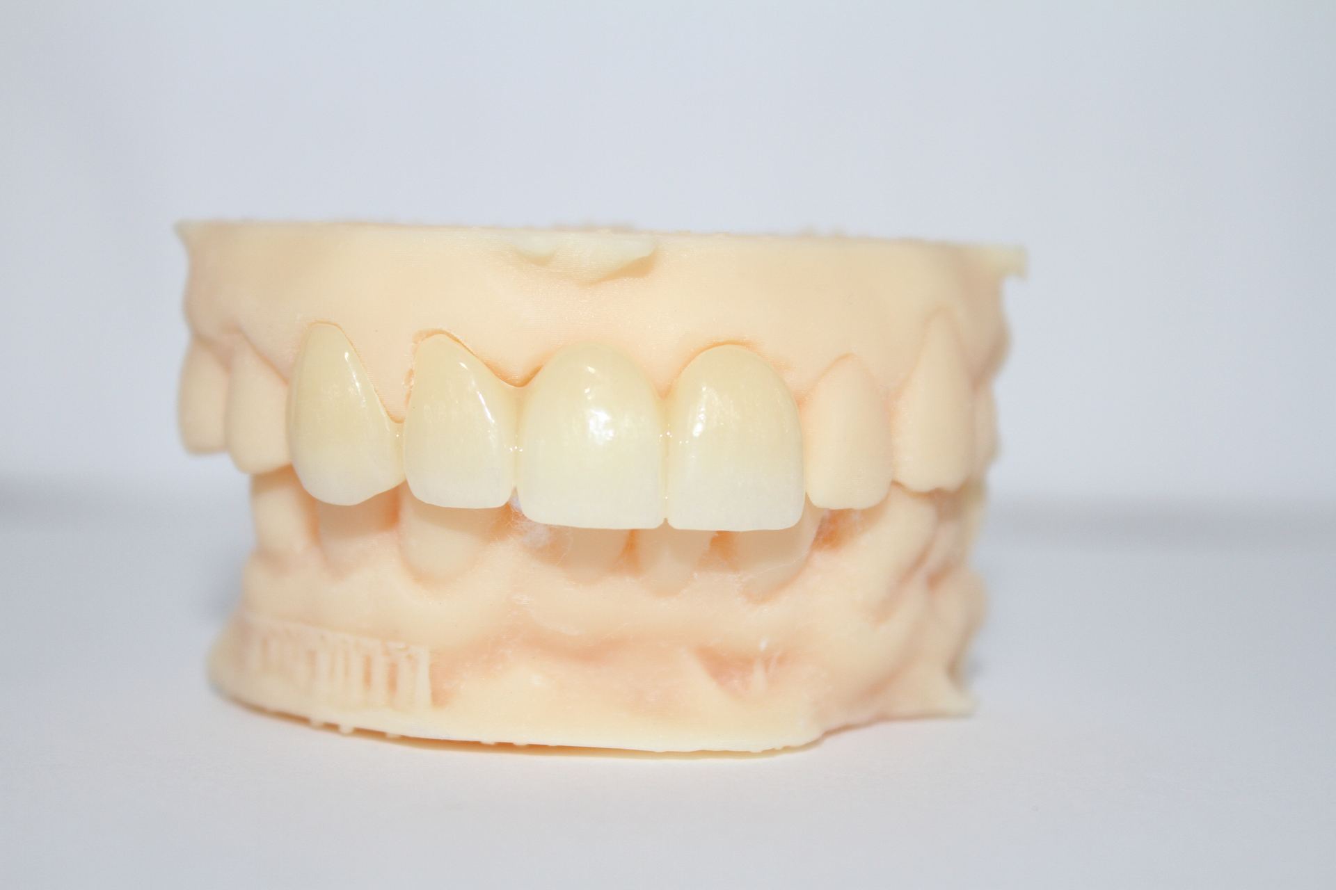 Modelo dental mostrando el resultado de un blanqueamiento dental